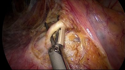EMICOLECTOMIA SINISTRA LAPAROSCOPICA 1