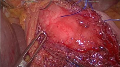 Fundoplicatio videolaparoscopica secondo Toupet. Roberto Petri, Massimo Vecchiato.
