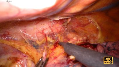 TRACHEA2